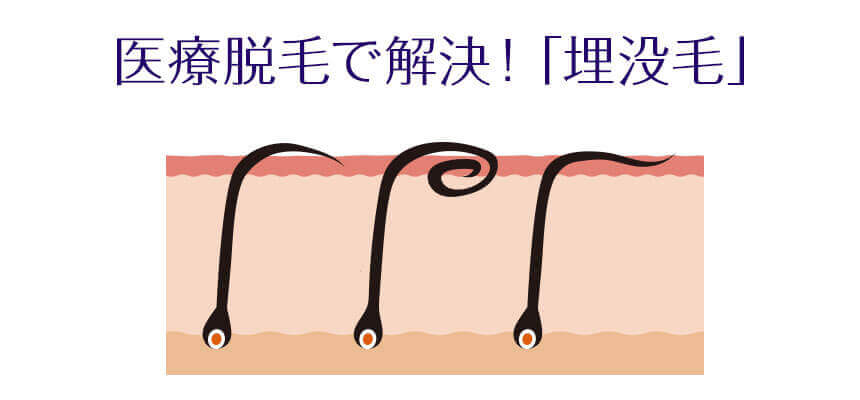 医療脱毛で解決 埋没毛が出来る原因と対策