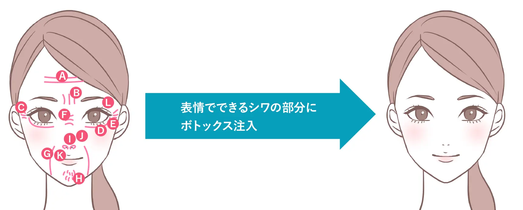 シワ取りボトックス 治療イメージ