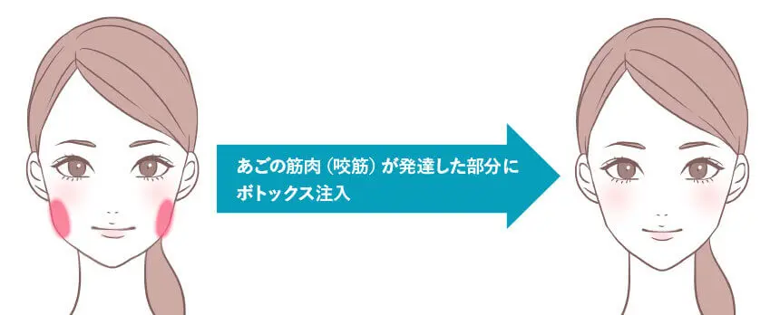 エラ（咬筋）ボトックス 治療イメージ