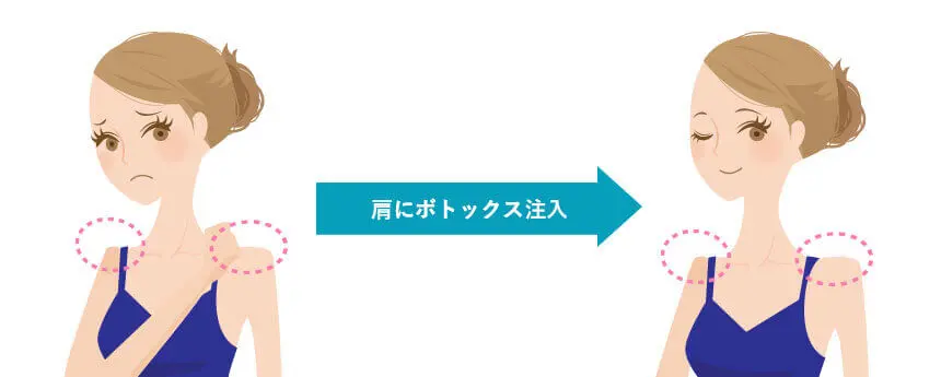肩こり改善ボトックス 治療イメージ