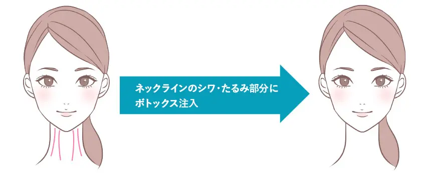 首ボトックス（シワ消し&リフトアップ）