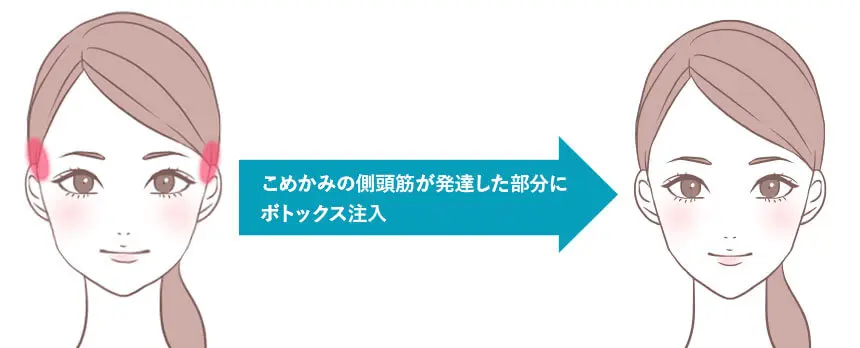 側頭筋ボトックス 治療イメージ