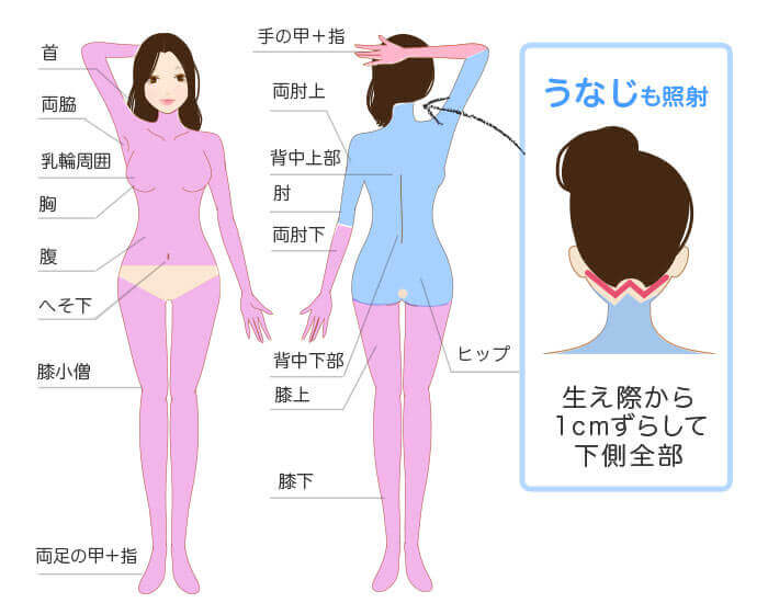 ジェントルマックスプロ×ソプラノ 全身+うなじ医療脱毛の照射範囲