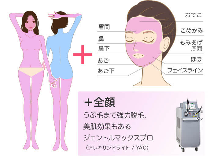 ジェントルマックスプロ×ソプラノ 全身+うなじ+顔 医療脱毛の照射範囲