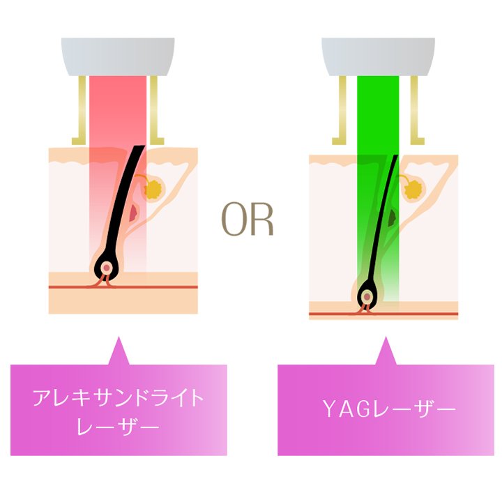 ジェントルマックスプロ