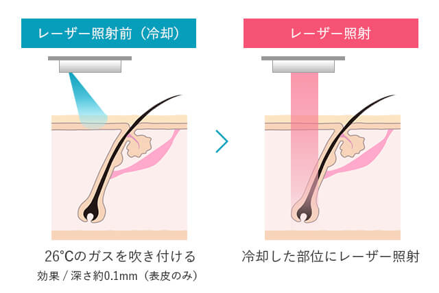 ジェントルマックスプロの照射時の痛みを軽減させる皮膚の冷却システム