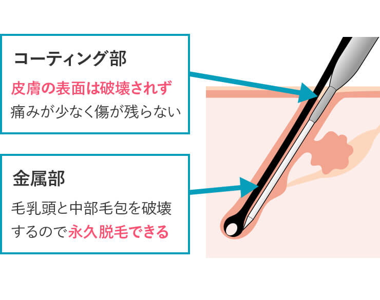 小林・山田式絶縁針による医療針脱毛