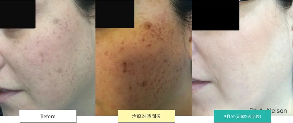 ルメッカ ビフォーアフター画像