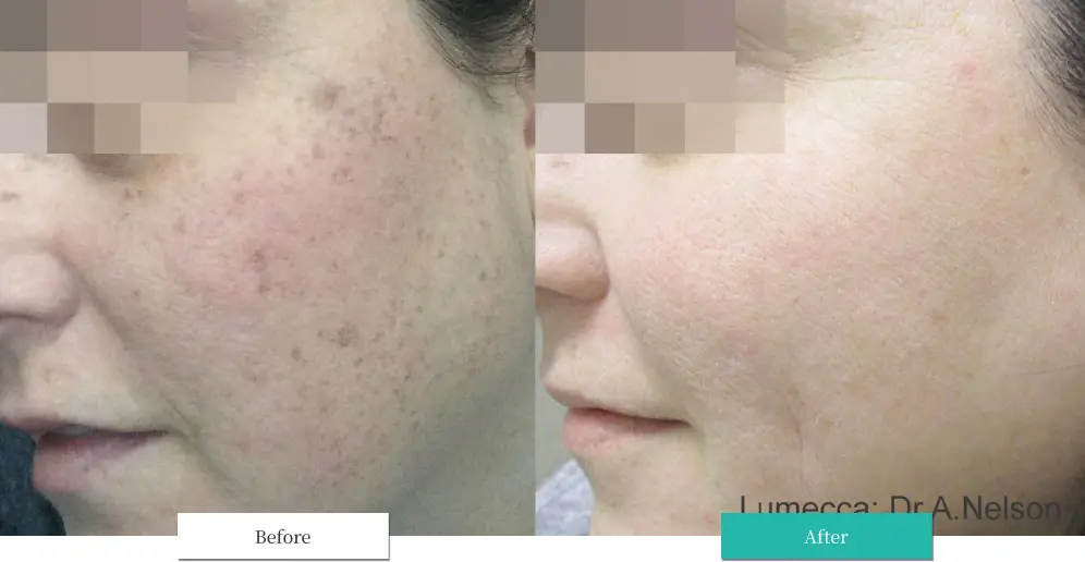 ルメッカ ビフォーアフター画像