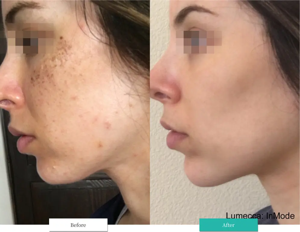 ルメッカ ビフォーアフター画像