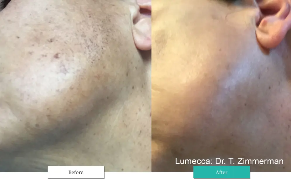 ルメッカ ビフォーアフター画像