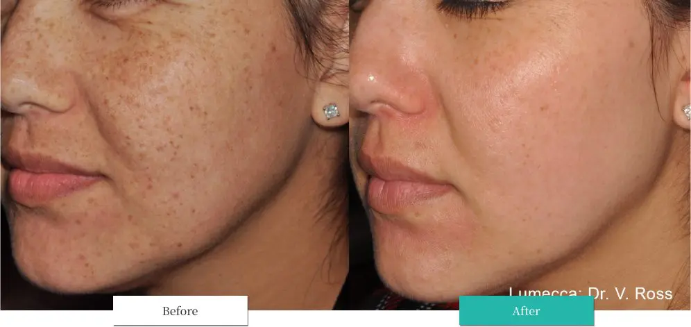 ルメッカ ビフォーアフター画像