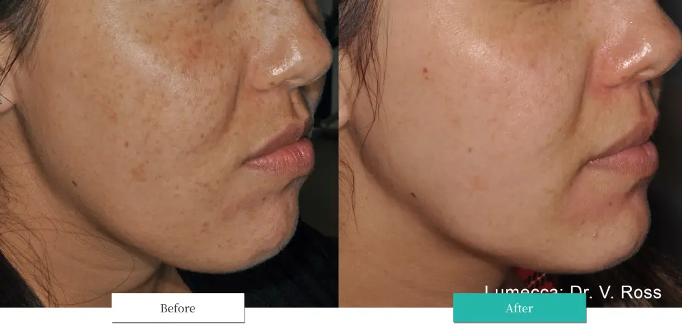 ルメッカ ビフォーアフター画像