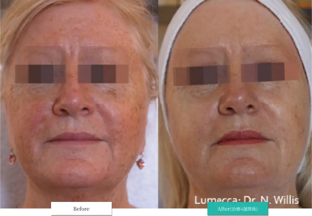 ルメッカ ビフォーアフター画像