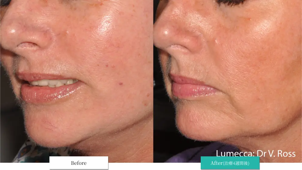 ルメッカ ビフォーアフター画像