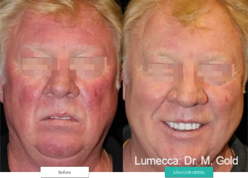 ルメッカ ビフォーアフター画像