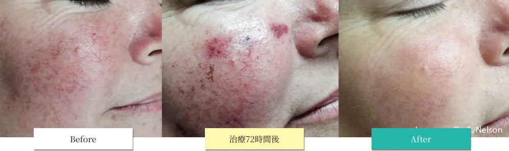 ルメッカ ビフォーアフター画像