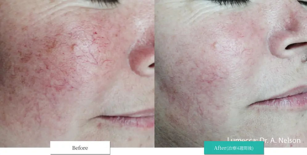 ルメッカ ビフォーアフター画像