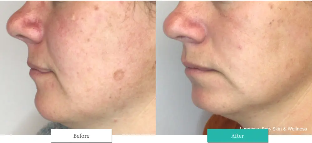 ルメッカ ビフォーアフター画像