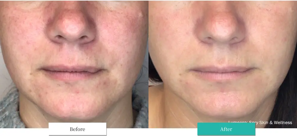 ルメッカ ビフォーアフター画像