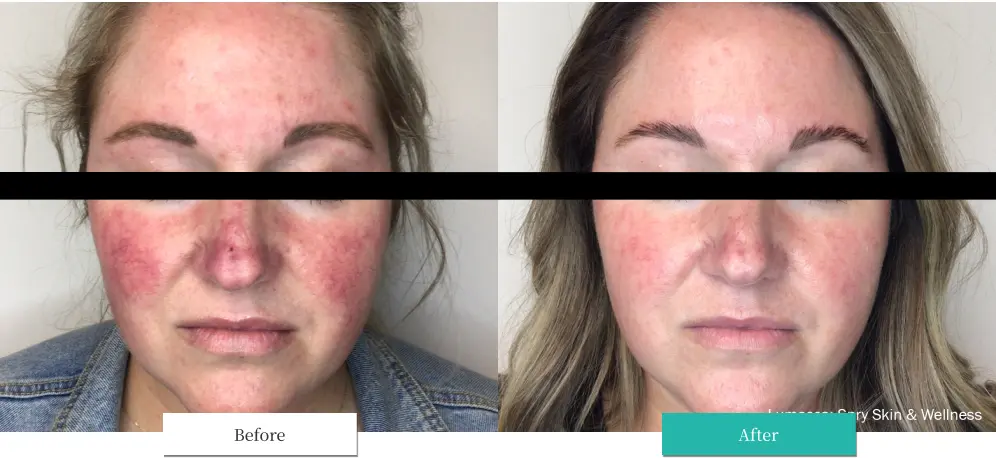 ルメッカ ビフォーアフター画像