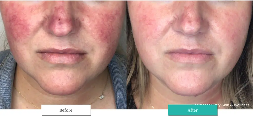 ルメッカ ビフォーアフター画像