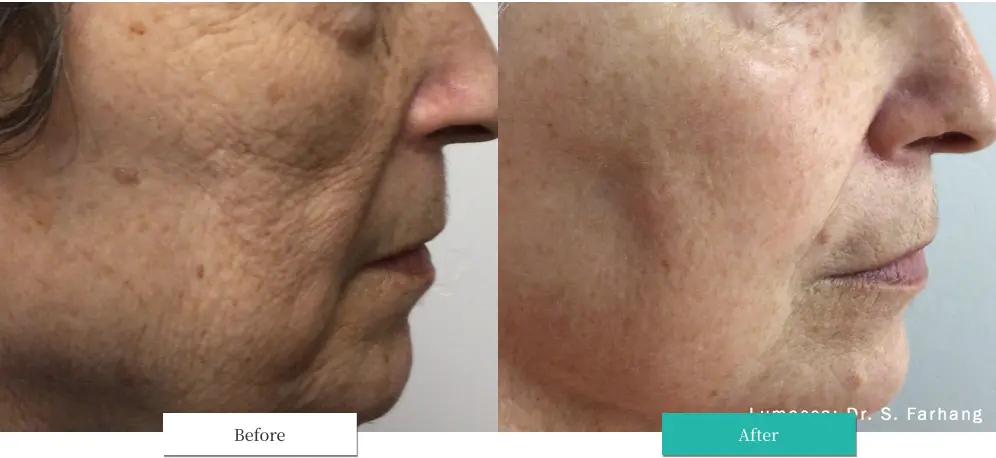 ルメッカ ビフォーアフター画像