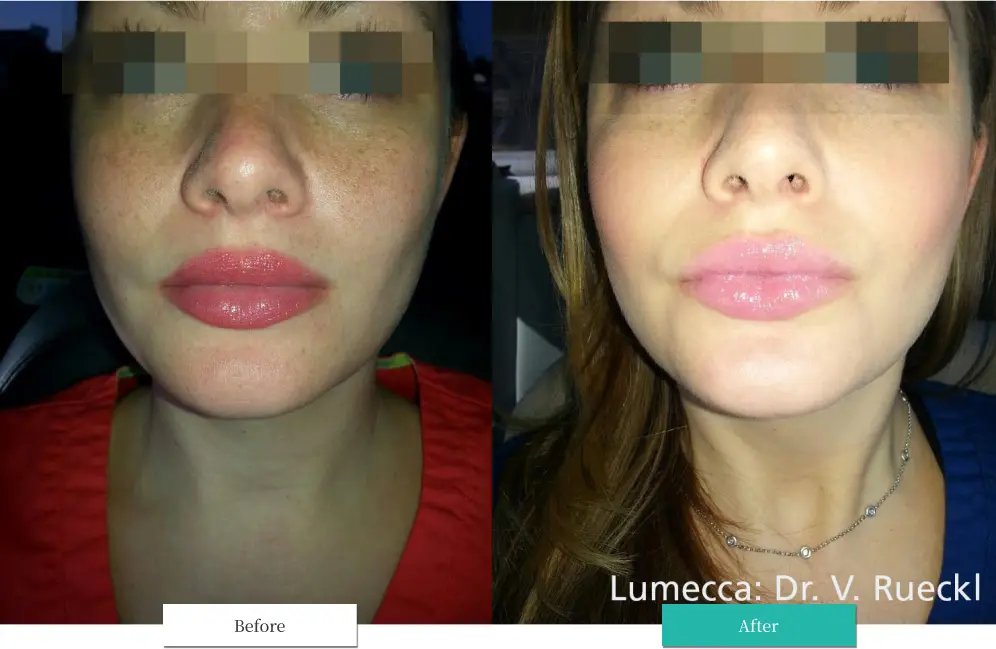 ルメッカ ビフォーアフター画像