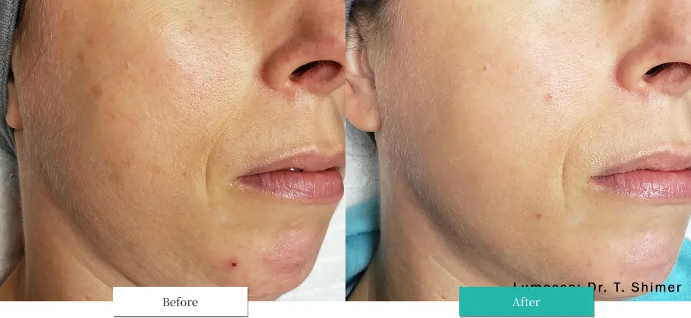 ルメッカ ビフォーアフター画像