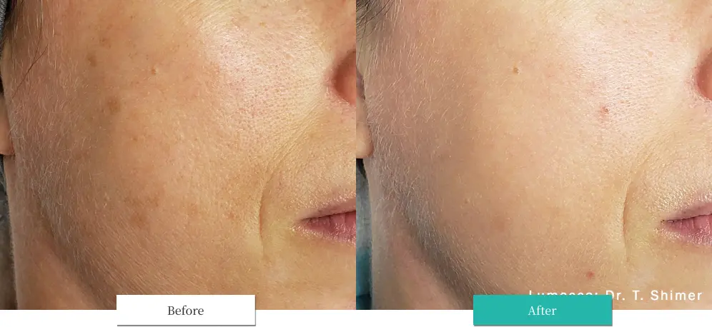 ルメッカ ビフォーアフター画像