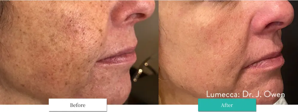 ルメッカ ビフォーアフター画像