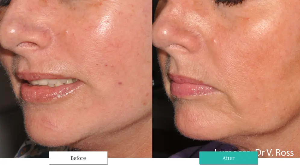 ルメッカ ビフォーアフター画像