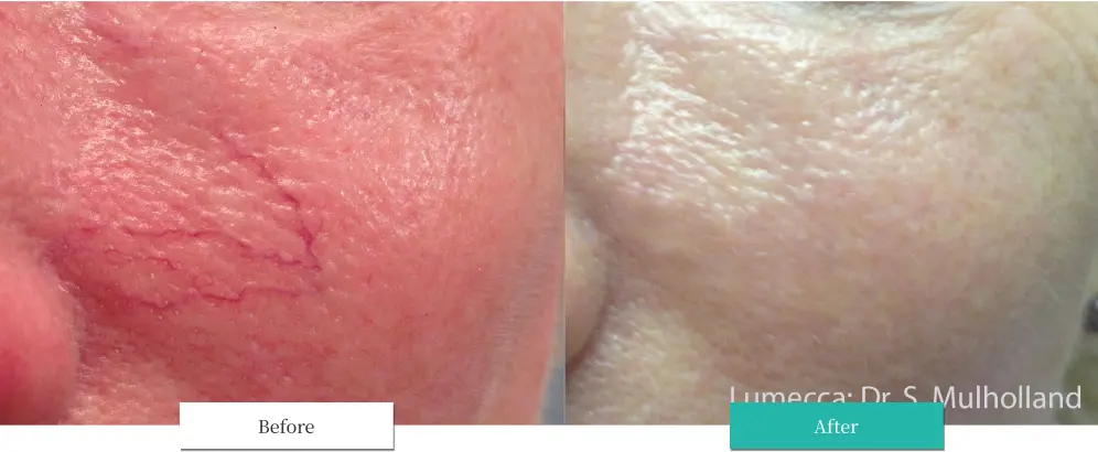 ルメッカ ビフォーアフター画像