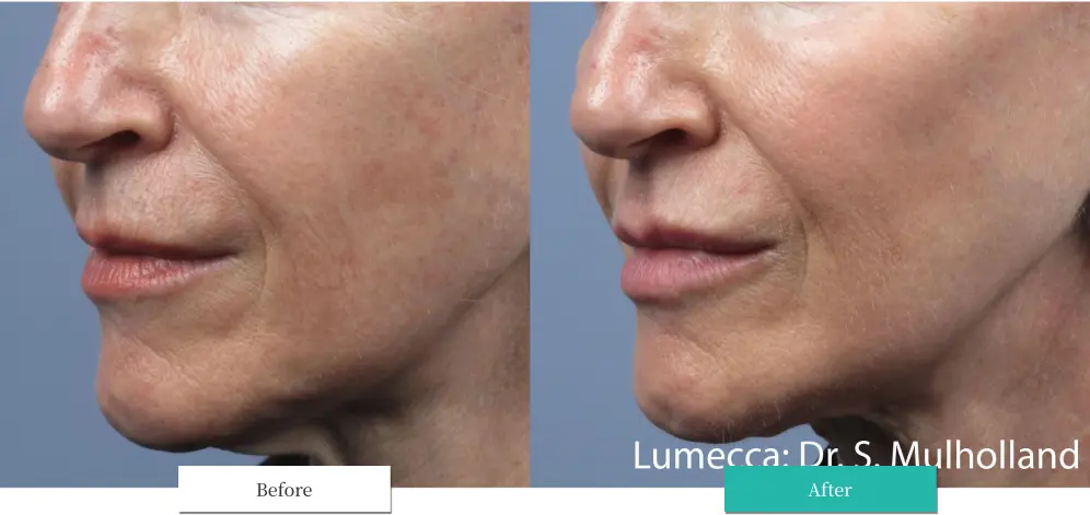 ルメッカ ビフォーアフター画像