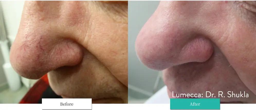 ルメッカ ビフォーアフター画像