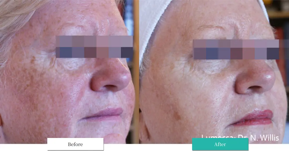 ルメッカ ビフォーアフター画像