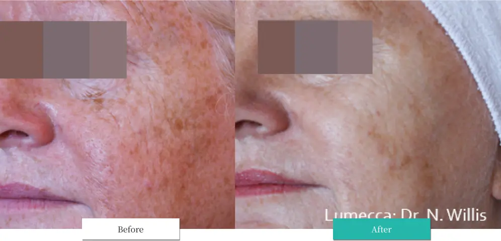 ルメッカ ビフォーアフター画像