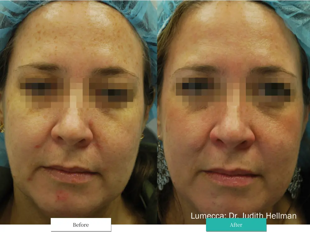 ルメッカ ビフォーアフター画像