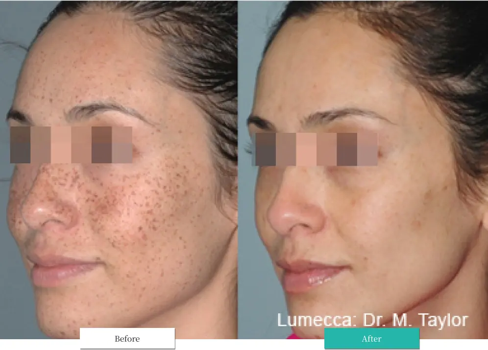 ルメッカ ビフォーアフター画像