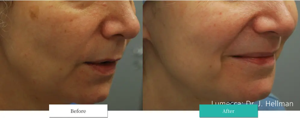 ルメッカ ビフォーアフター画像