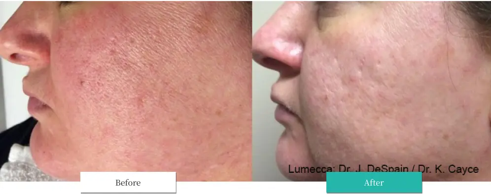 ルメッカ ビフォーアフター画像