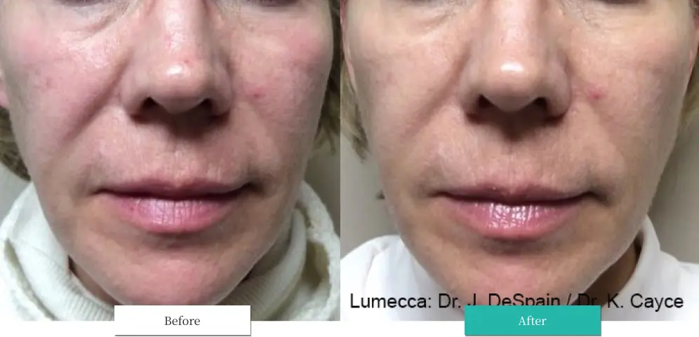 ルメッカ ビフォーアフター画像