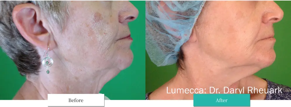 ルメッカ ビフォーアフター画像