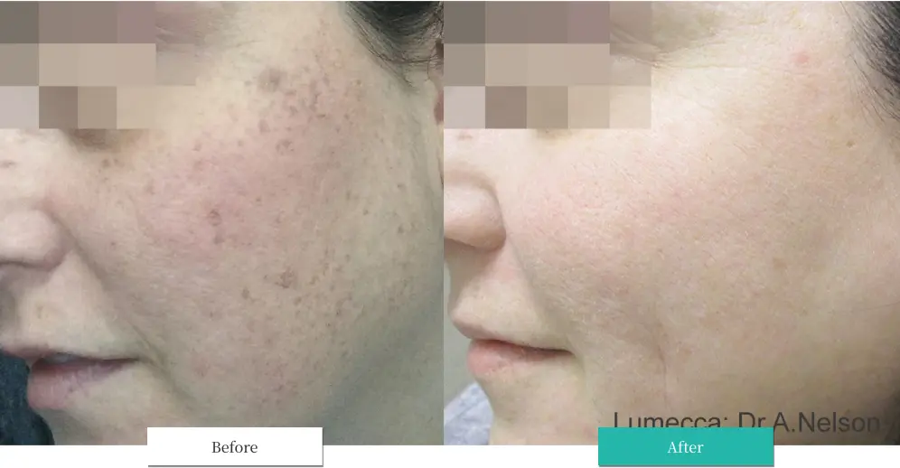 ルメッカ ビフォーアフター画像