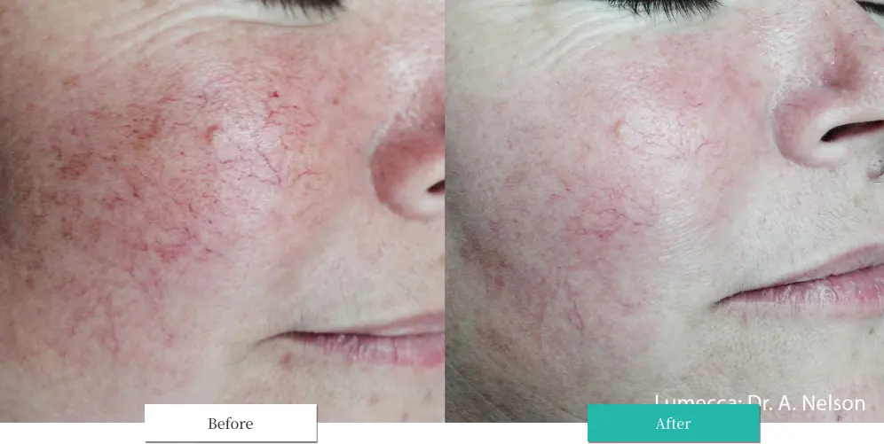 ルメッカ ビフォーアフター画像