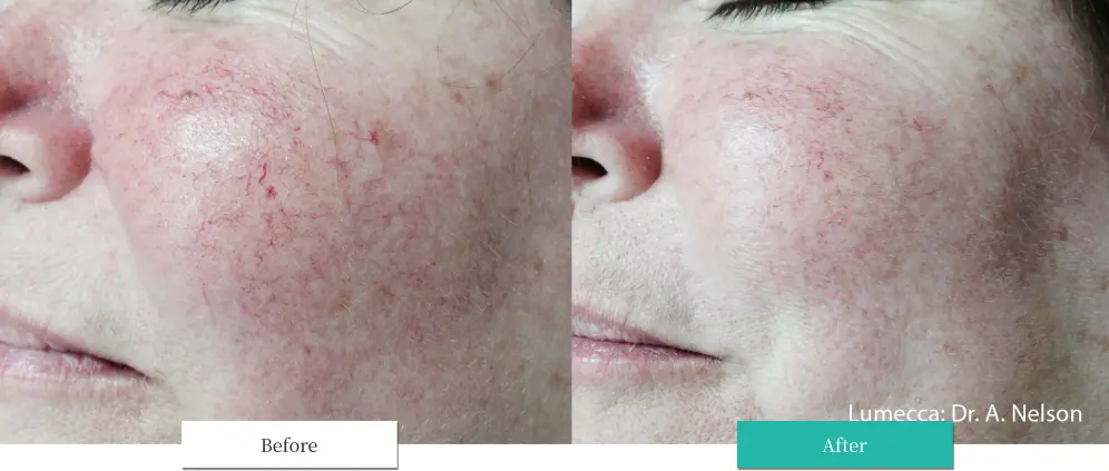 ルメッカ ビフォーアフター画像