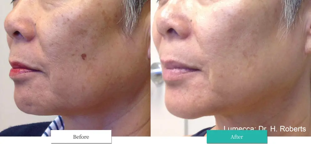 ルメッカ ビフォーアフター画像