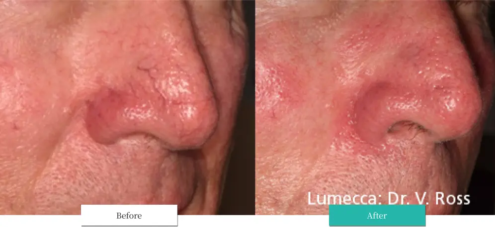 ルメッカ ビフォーアフター画像