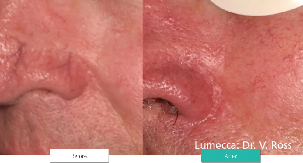 ルメッカ ビフォーアフター画像