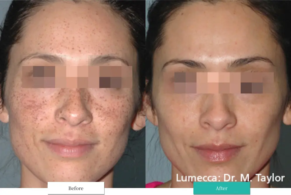 ルメッカ ビフォーアフター画像